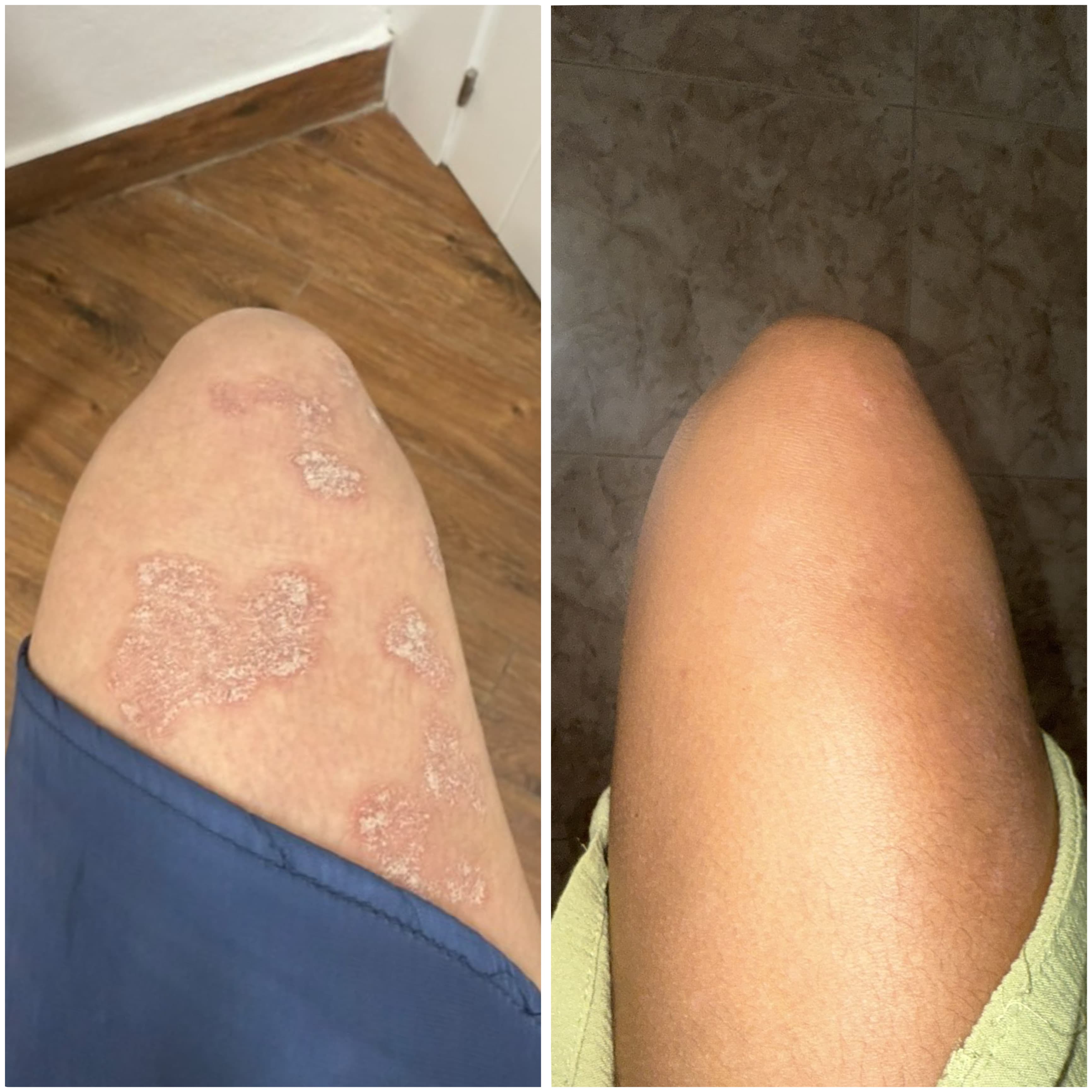 Crema CBD Riparatrice per pelle secca, desquamata e a tendenza psoriasica