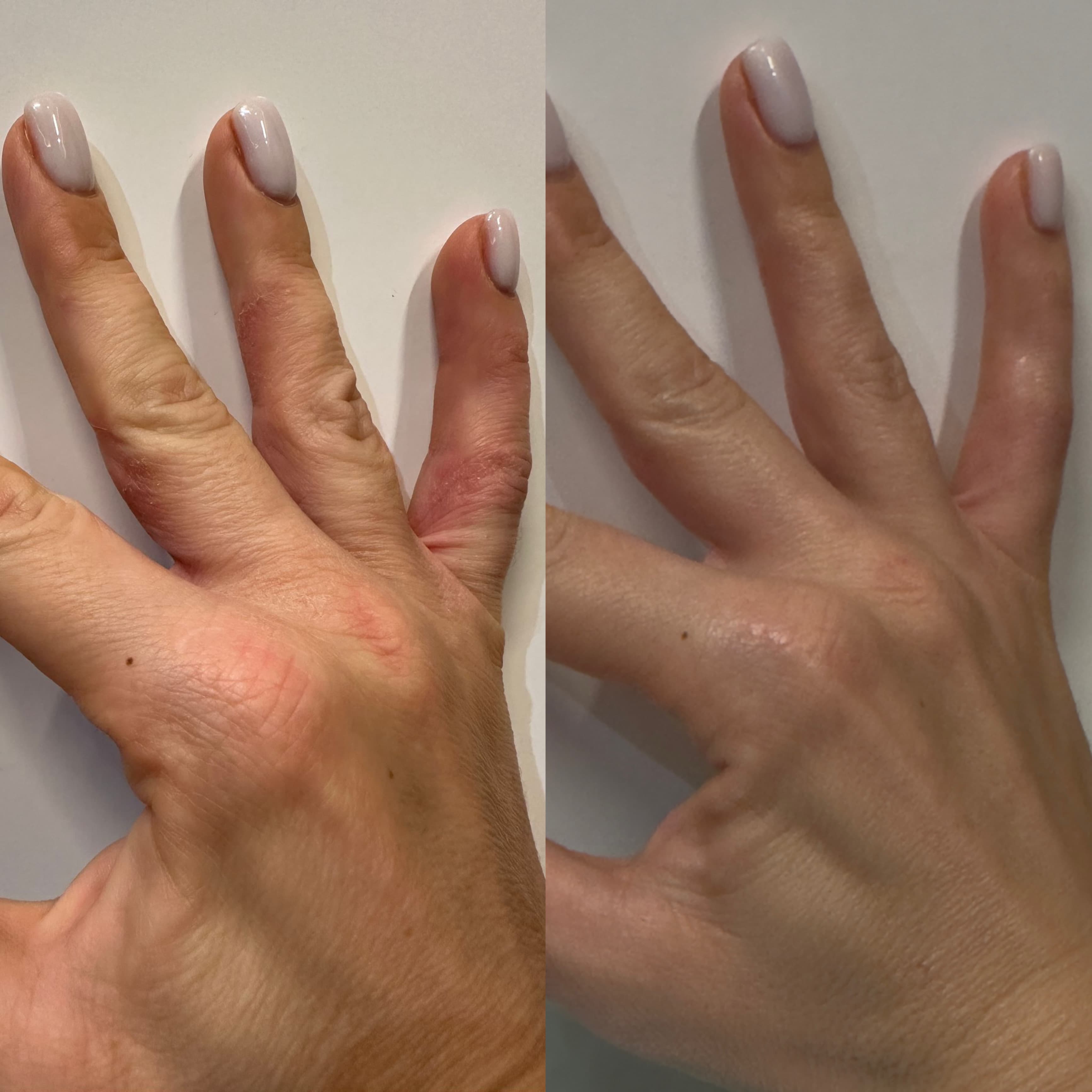 Buy CBD Cream for Eczema-Prone Skin