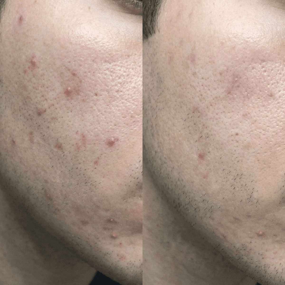 Crema CBD Purificante Anti-imperfezioni per pelli a tendenza acneica