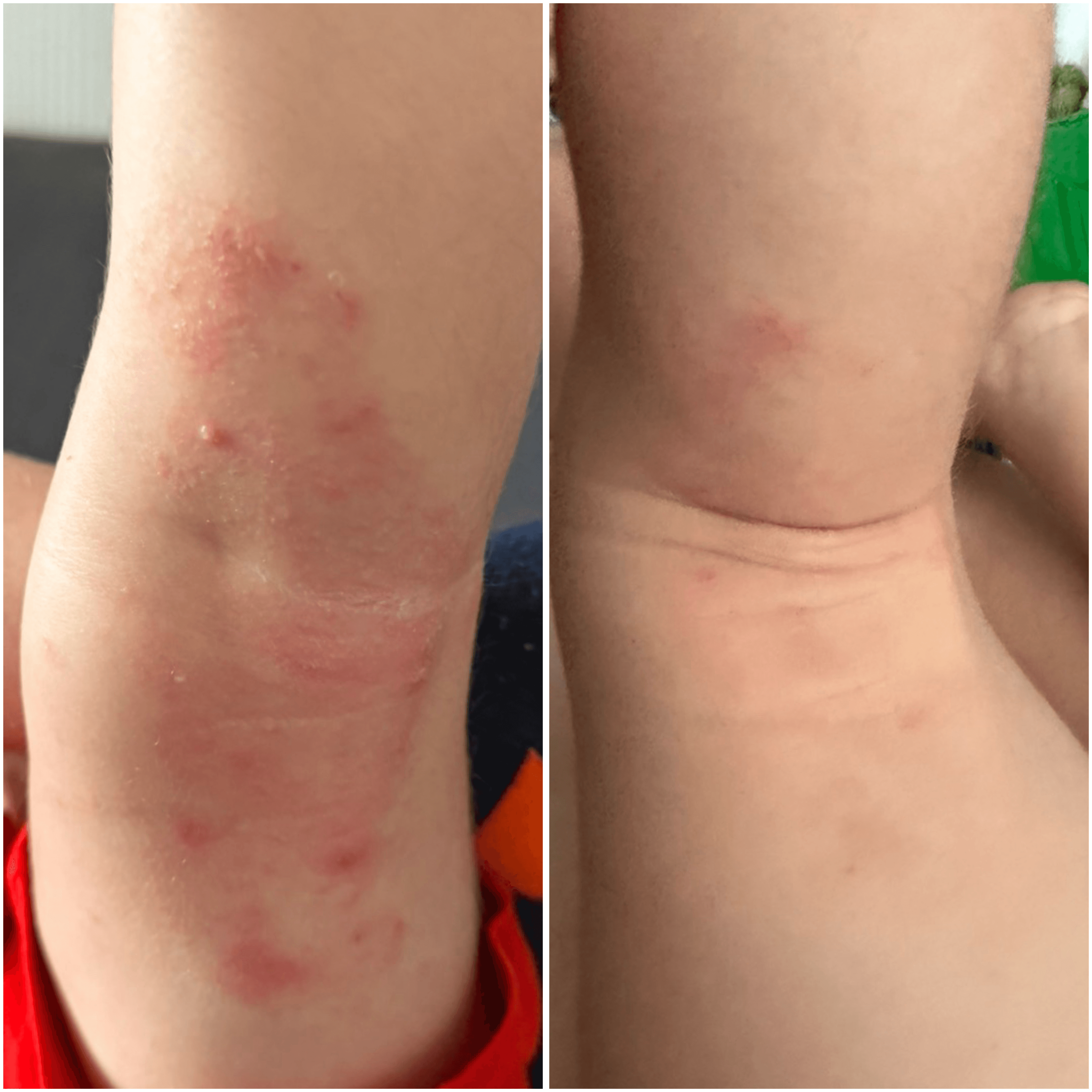 Crema CBD per pelle secca, atopica ed eczematosa
